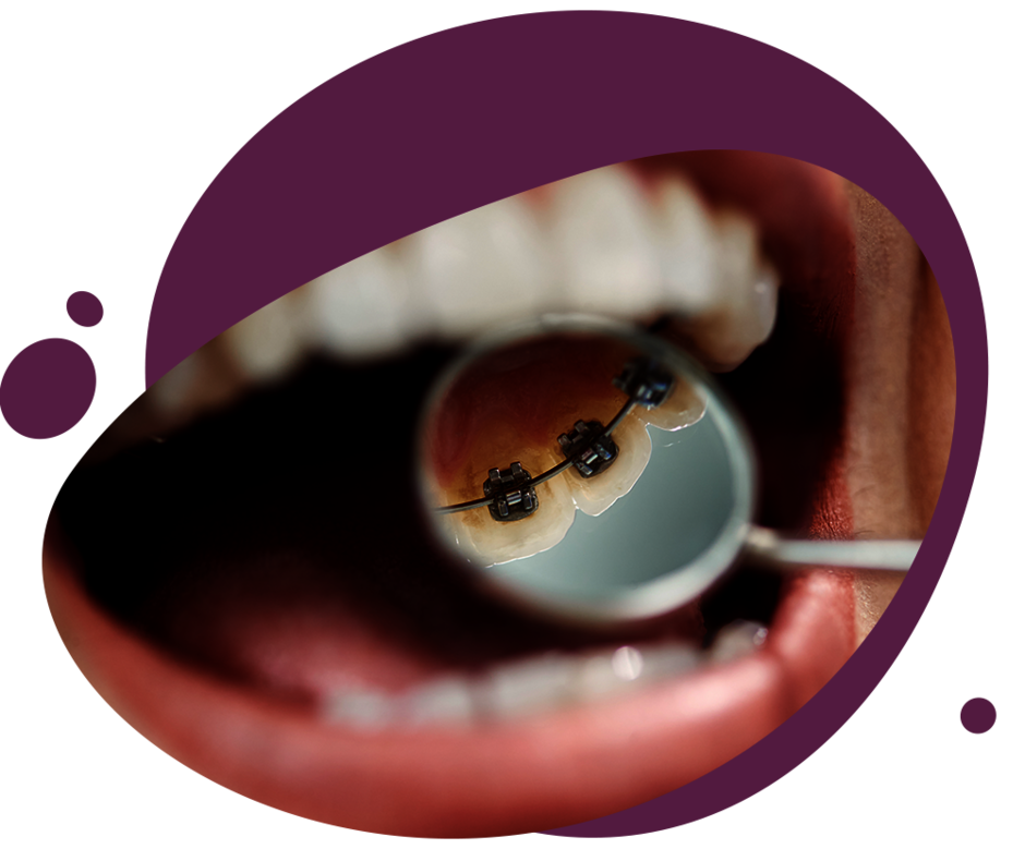 Nahaufnahme eines Mundes, in dem man durch einen Dentalspiegel einen innenliegende Zahnspange sieht