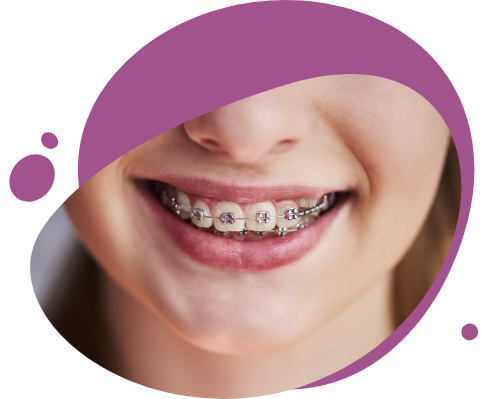 Nahaufnahme eines lächelnden Mundes mit einer festen Zahnspange