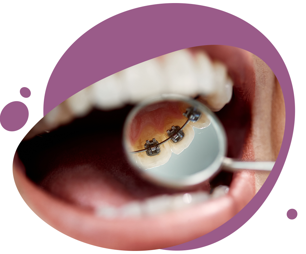 Nahaufnahme von einem MunIn der kieferorthopädischen Praxis formbar Forchheim lacht ein Mädchen mit einer festen Zahnspange in die Kamerad, in dem man durch einen Dentalspiegel einen innenliegende Zahnspange sieht Nahaufnahme eines Mundes, in dem man durch einen Dentalspiegel einen innenliegende Zahnspange sieht